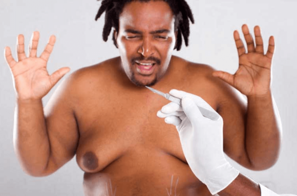 MALE BREASTS REDUCTION
