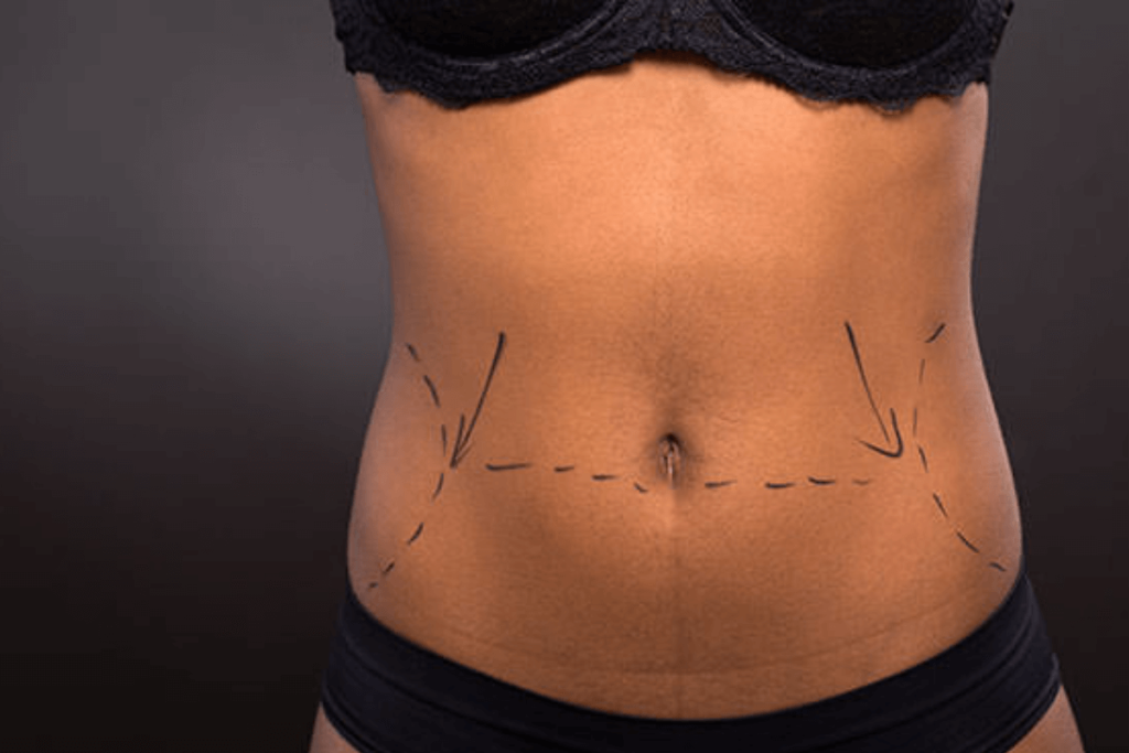 Tummy Tuck