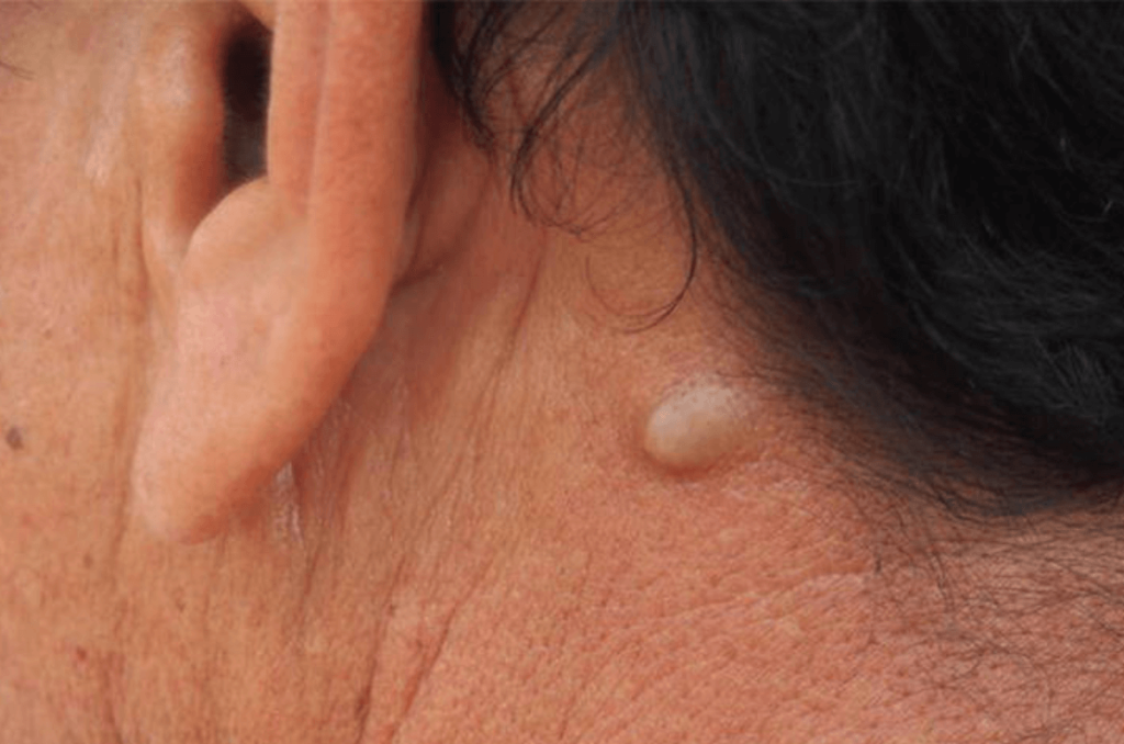cysts