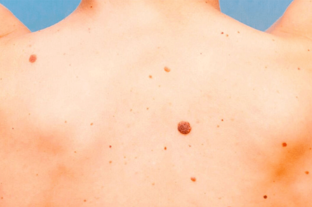 moles