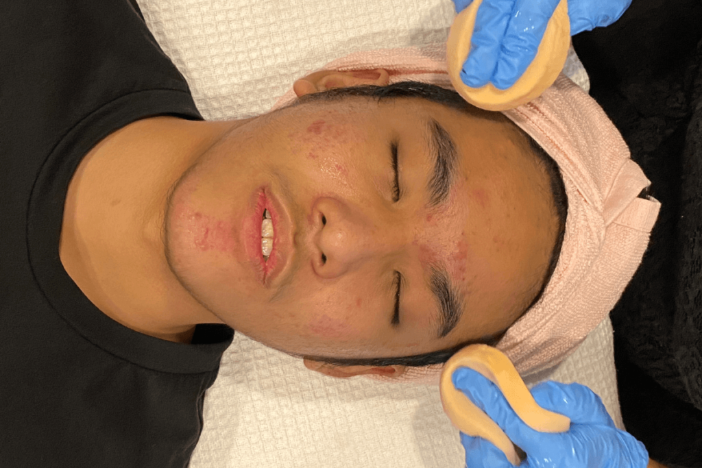 Acne Treatment_1