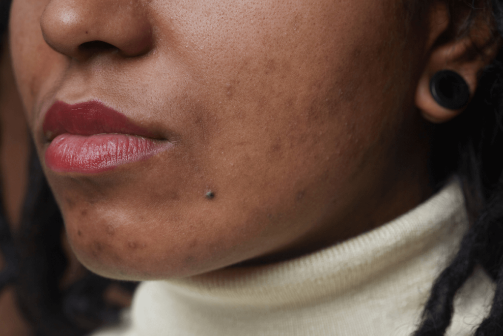 Hyperpigmentation
