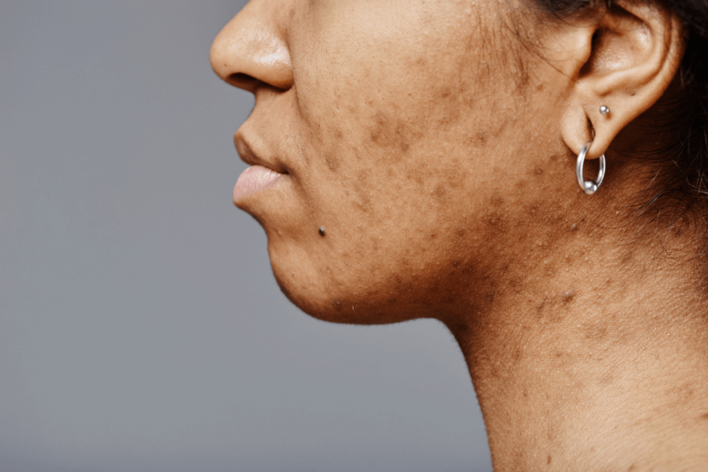 Hyperpigmentation_2