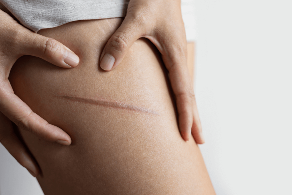 Scar Revision