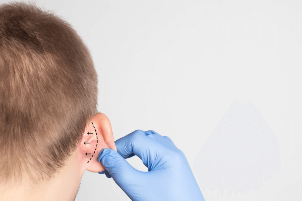 Otoplasty_2
