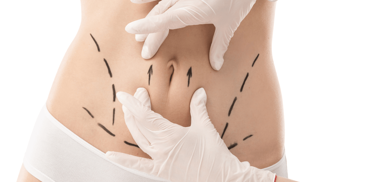 Body Contouring Procedure