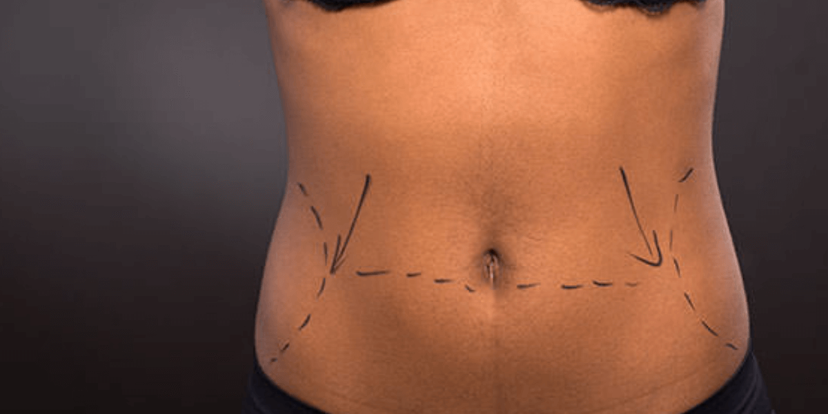 Tummy Tuck